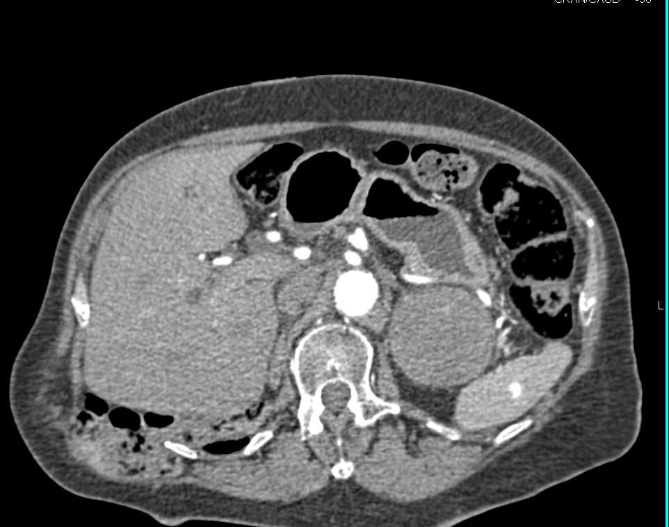 Left Adrenal Metastases from a Renal Primary - CTisus CT Scan