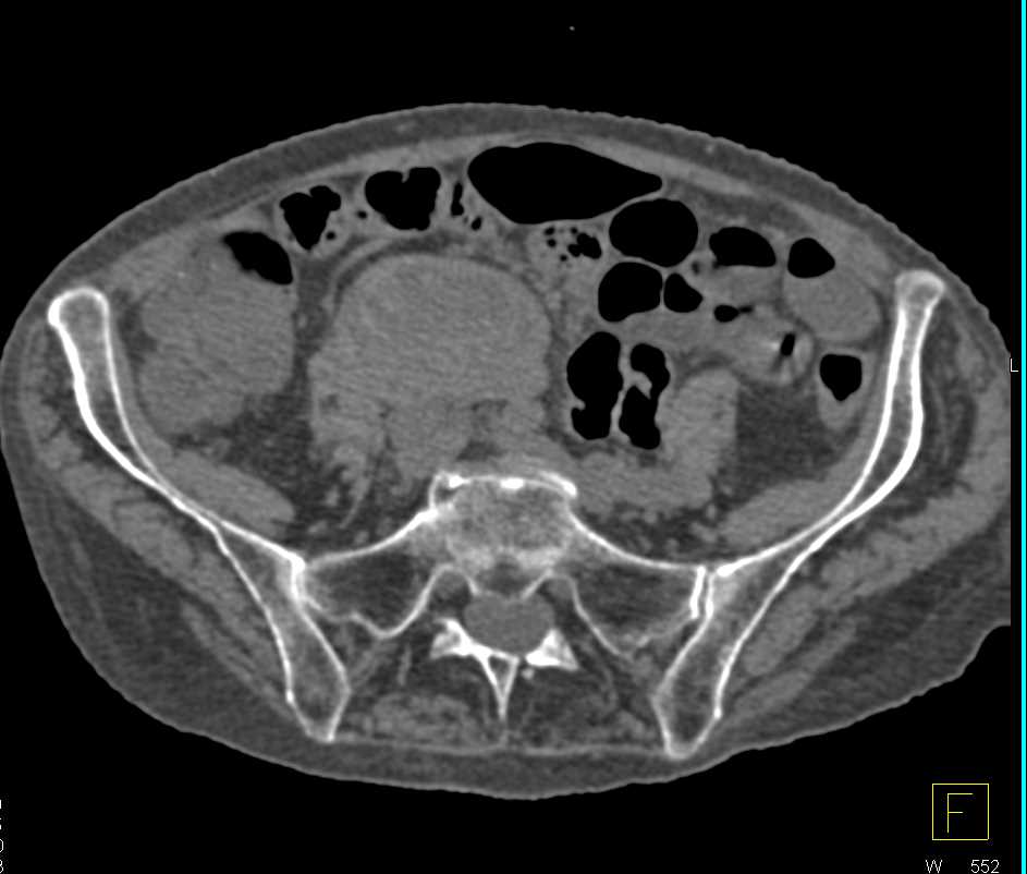 Renal Cell Carcinoma Right Kidney with Adenopathy - CTisus CT Scan