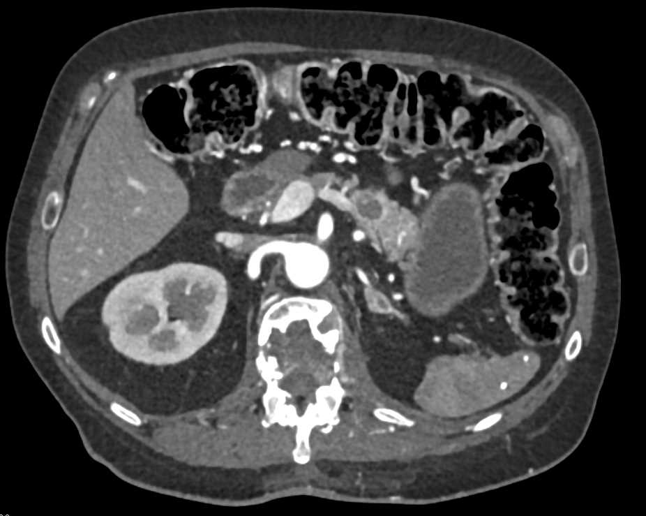 Left Nephrectomy for Renal Cell Carcinoma (RCC) with Metastases to the Pancreas and Left Adrenal - CTisus CT Scan