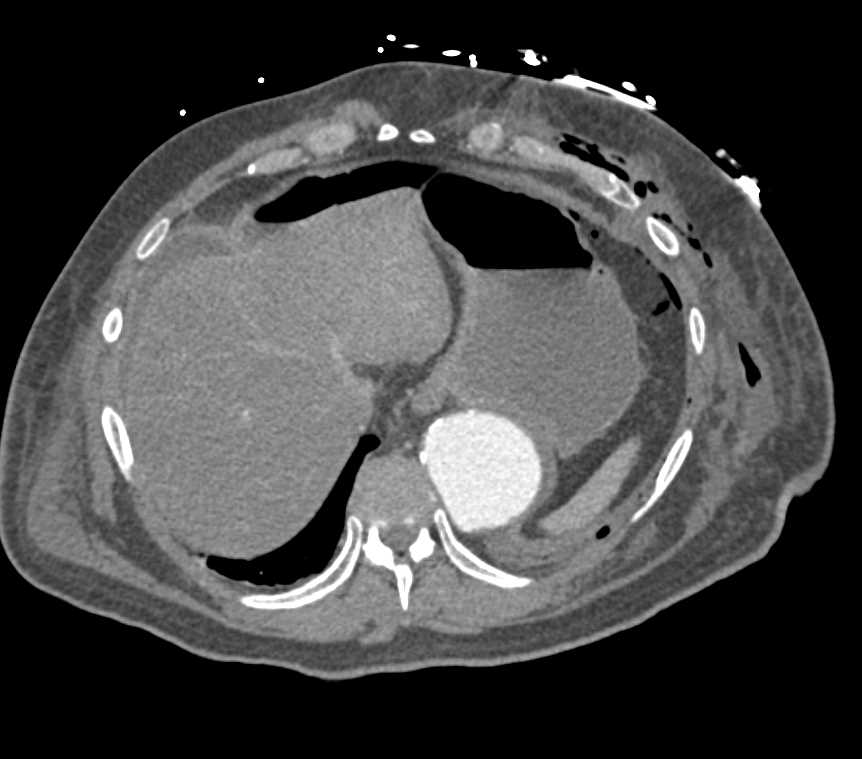 Infarcted Left Kidney s/p Vascular Surgery - CTisus CT Scan