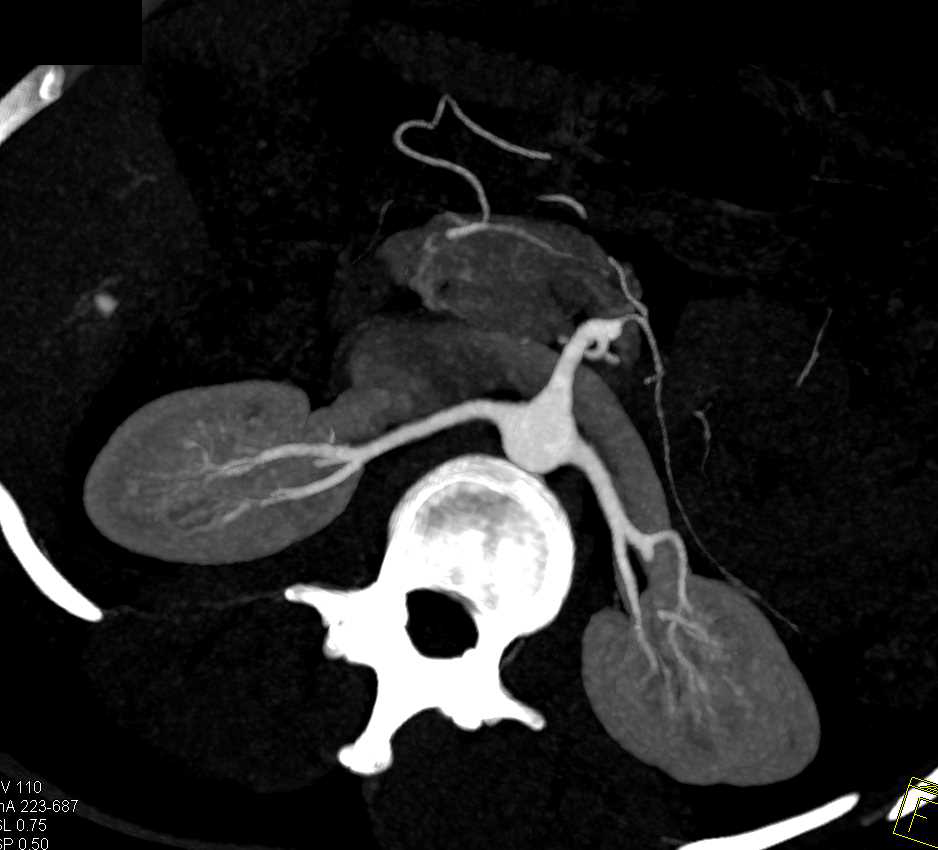 Arteriovenous Malformation (AVM) Right Renal Pelvis - CTisus CT Scan