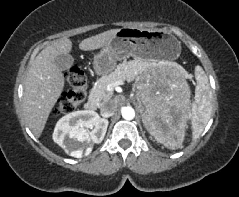 Clear Cell Renal Cell Carcinoma (CCRCC) Invades the Left Renal Vein and the Inferior Vena Cava (IVC) - CTisus CT Scan