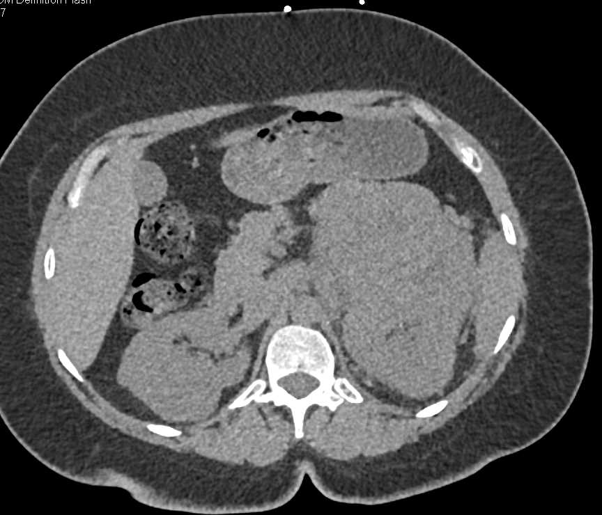 Clear Cell Renal Cell Carcinoma (CCRCC) Invades the Left Renal Vein and the Inferior Vena Cava (IVC) - CTisus CT Scan
