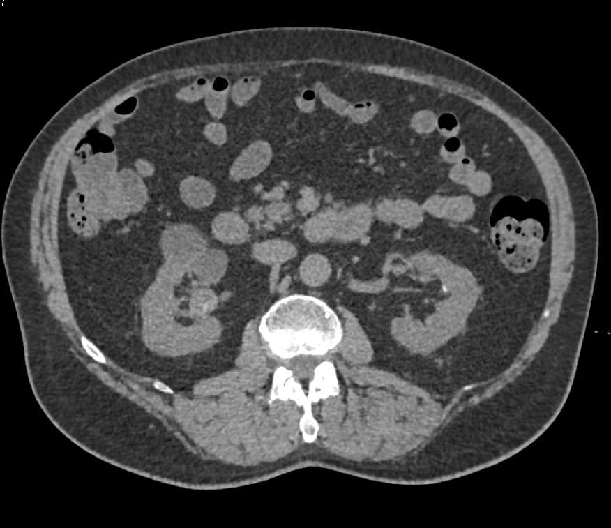 Multiple Complex Renal Cysts - CTisus CT Scan