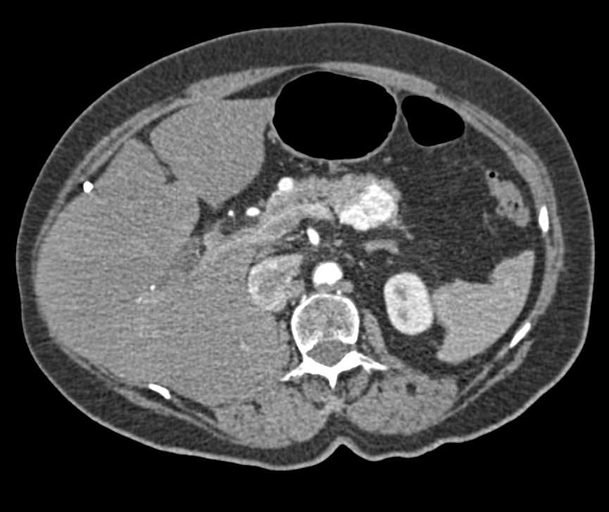 Recurrent Renal Cell Carcinoma to Contralateral Kidney and the Pancreas - CTisus CT Scan