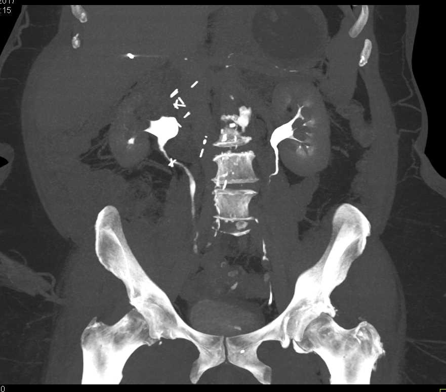 Prominent Medullary Rays Left Kidney - CTisus CT Scan