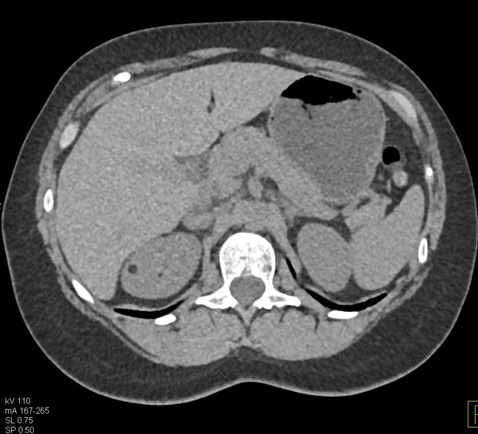 1cm Angiomyolipoma (AML) Right Kidney - CTisus CT Scan