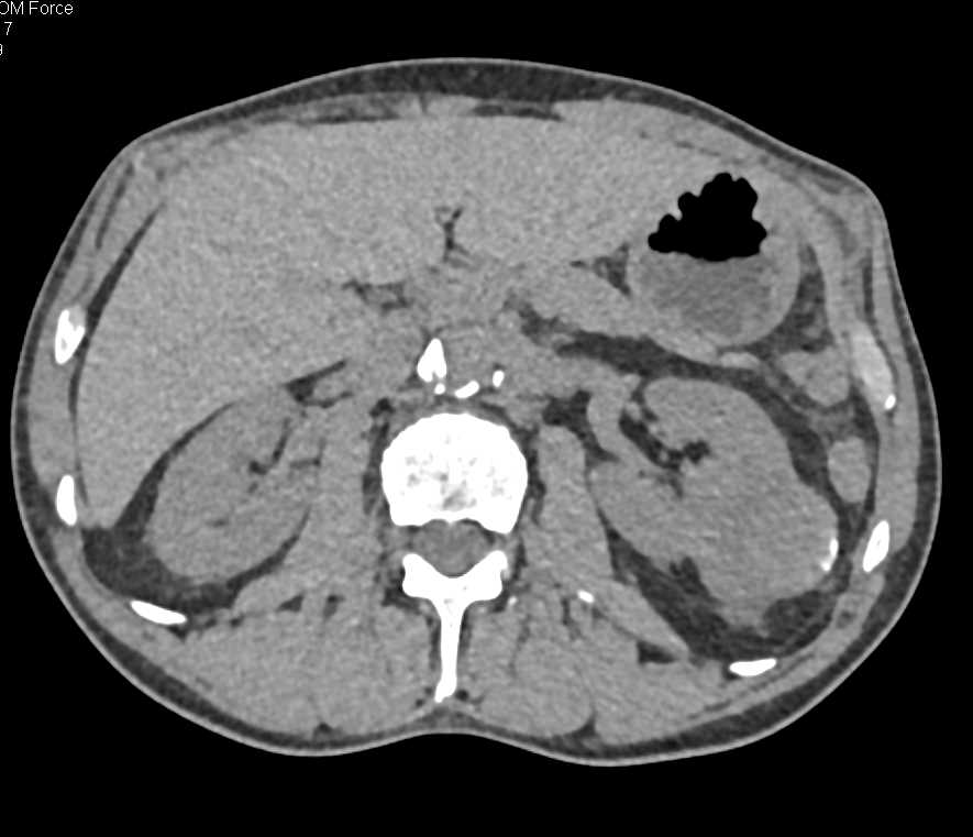 Dystrophic Calcification in a Left Renal Cell Carcinoma - CTisus CT Scan