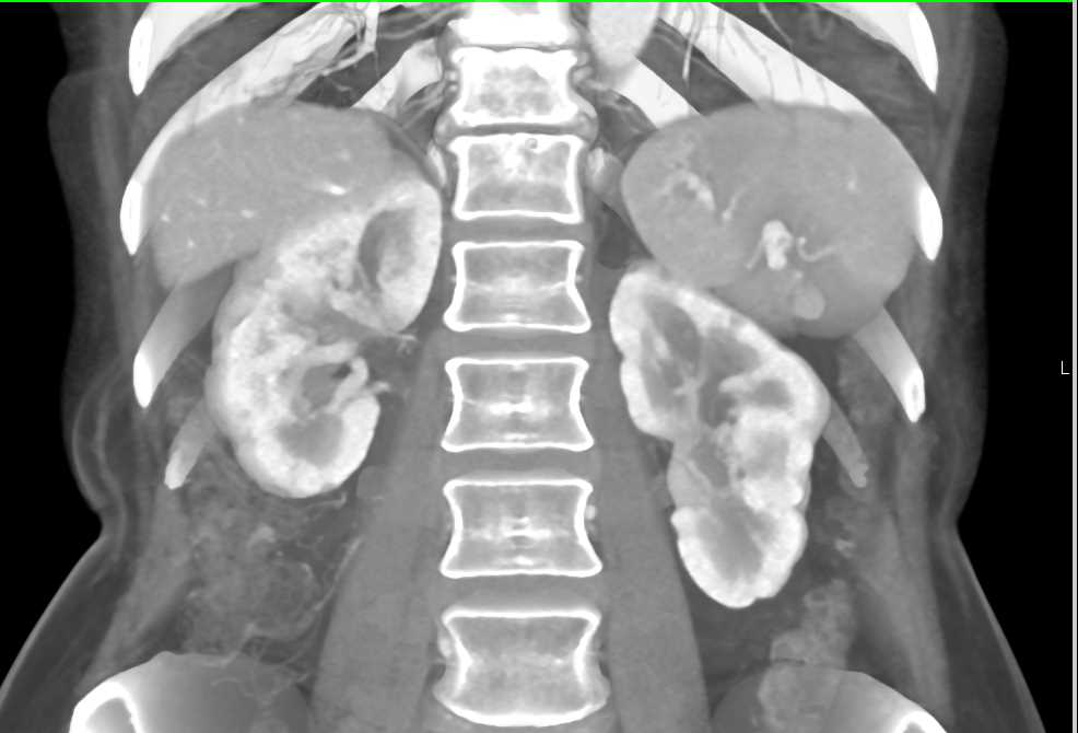 Papillary Necrosis - CTisus CT Scan