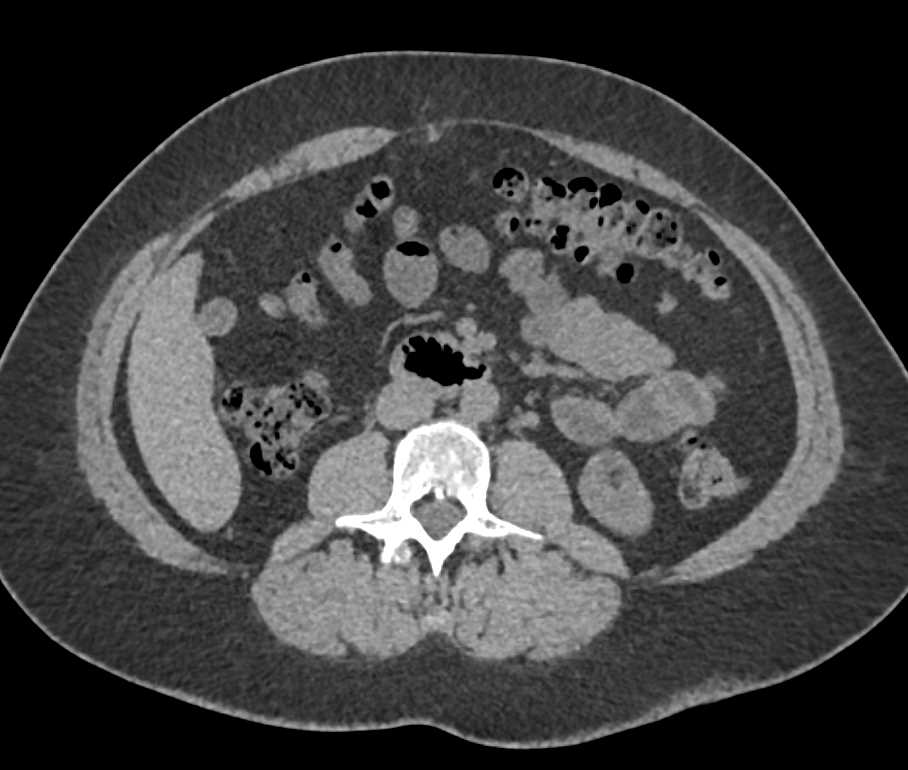 1cm Angiomyolipoma (AML) Lower Pole Left Kidney - CTisus CT Scan