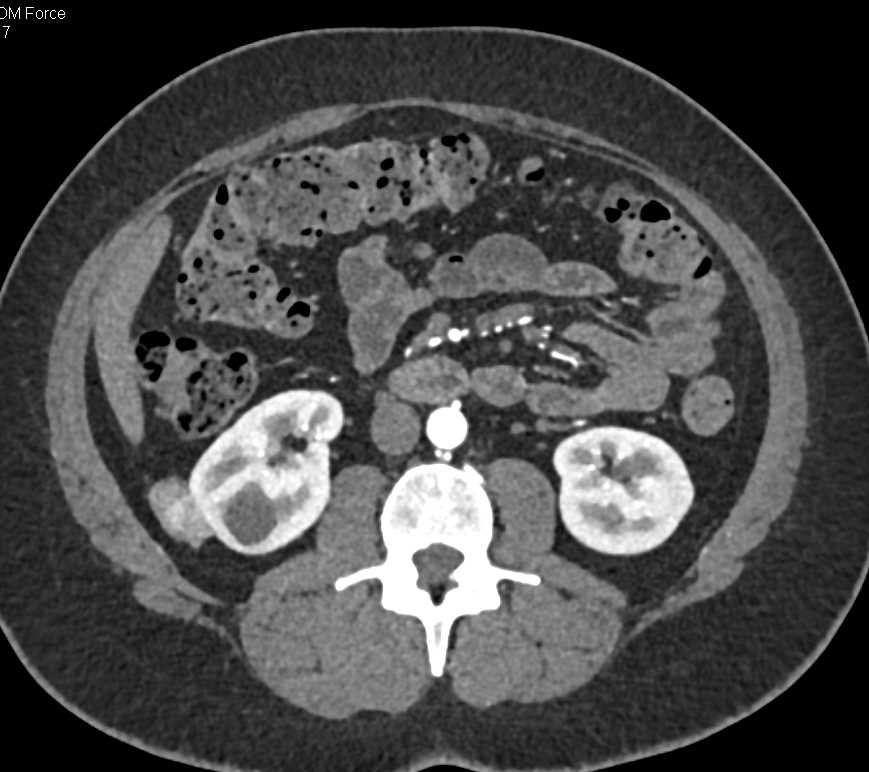 Metastatic Melanoma to the Right Pararenal Space - CTisus CT Scan