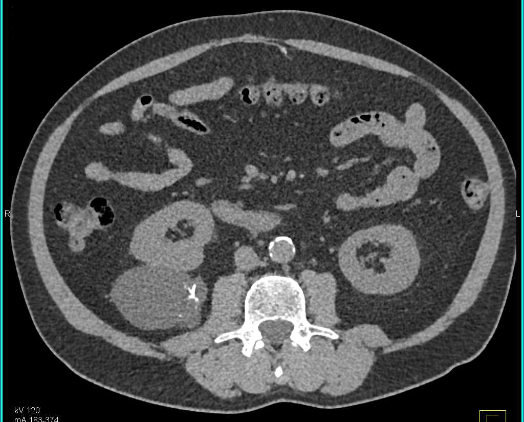 Bosniak 2F Cyst - CTisus CT Scan