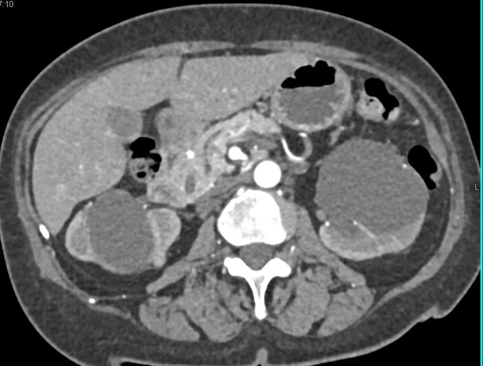 1cm High Density Right Renal Cyst - CTisus CT Scan