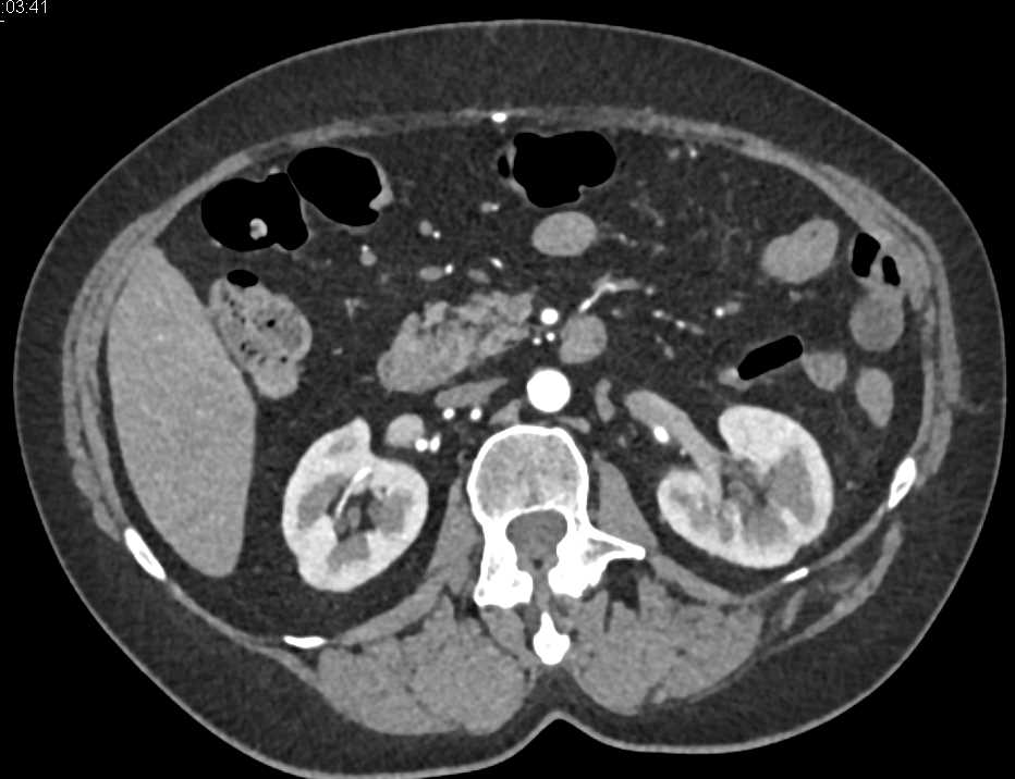 Acute Pyelonephritis Left Kidney - CTisus CT Scan