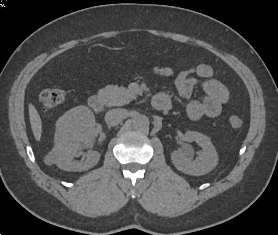 Clear Cell Renal Cell Carcinoma - CTisus CT Scan