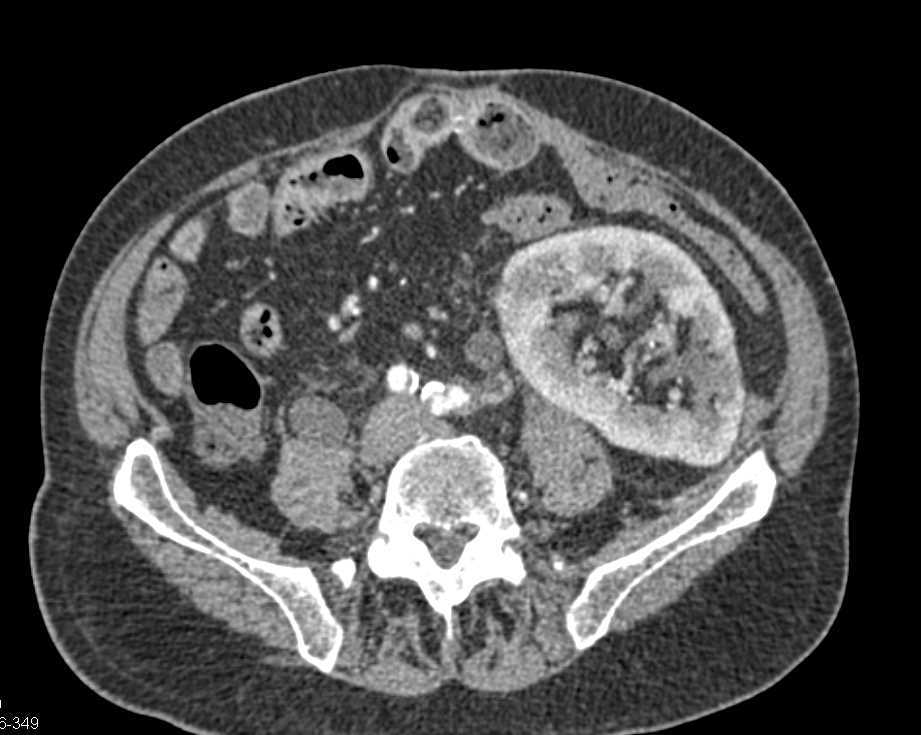 Acute Pyelonephritis in the Transplanted Kidney - CTisus CT Scan