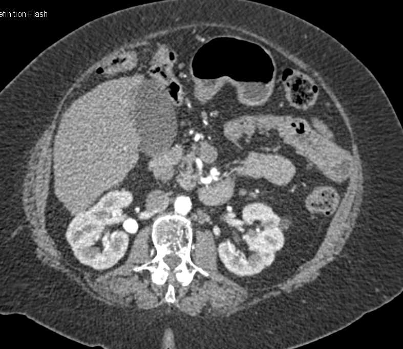 Right Renal Artery Aneurysm - CTisus CT Scan