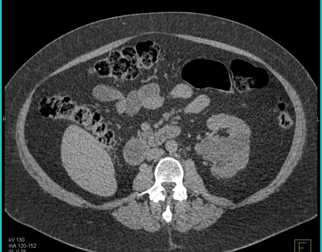 Left Renal Cysts - CTisus CT Scan