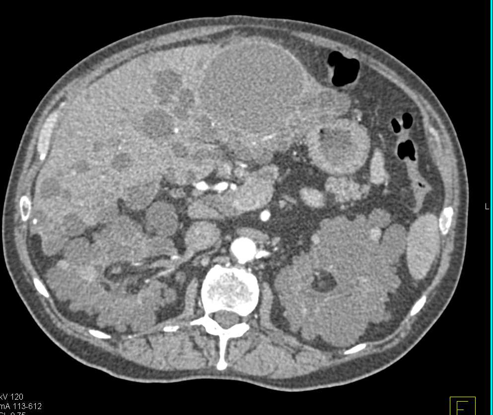 Polycystic Kidney Disease and Polycystic Liver Disease - CTisus CT Scan