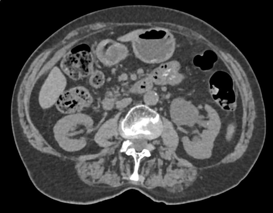 Transitional Cell Carcinoma in the Left Distal Ureter - CTisus CT Scan