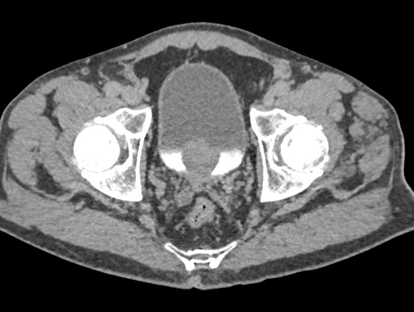 Oncocytoma Left Kidney and Multiple Cysts - CTisus CT Scan