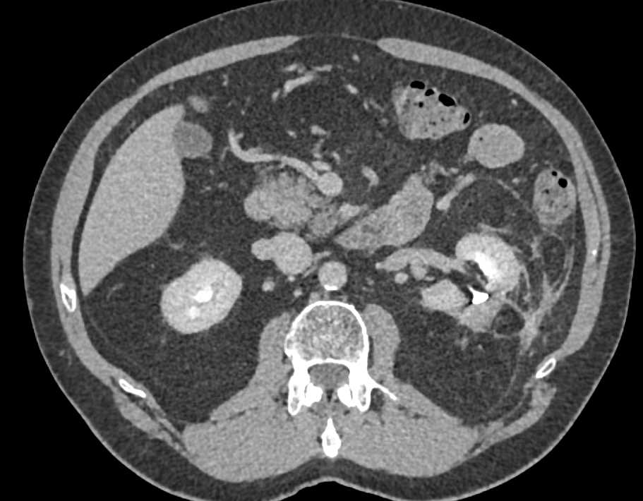Partial Left Nephrectomy with Pseudoaneurysm Left Kidney - CTisus CT Scan