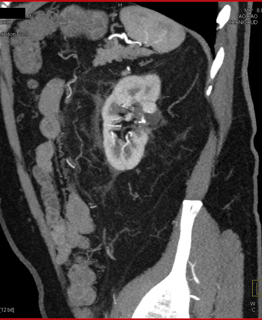 Partial Left Nephrectomy with Pseudoaneurysm Left Kidney - CTisus CT Scan