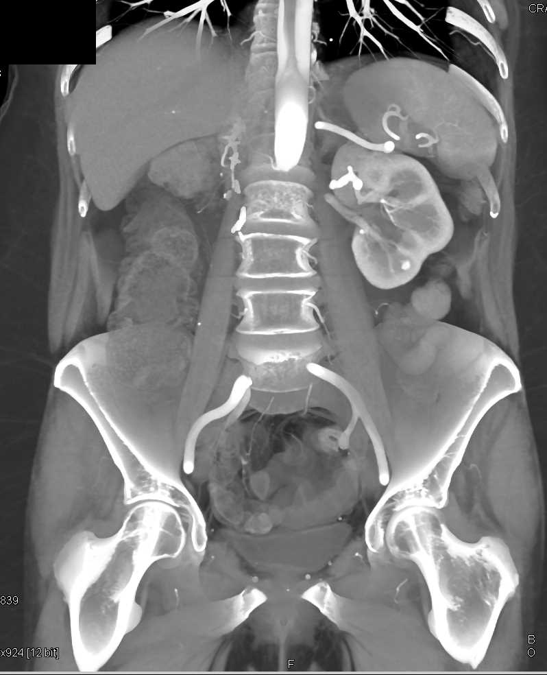 2cm Clear Cell Renal Cell carcinoma Left Kidney in Patient with Prior Nephrectomy - CTisus CT Scan