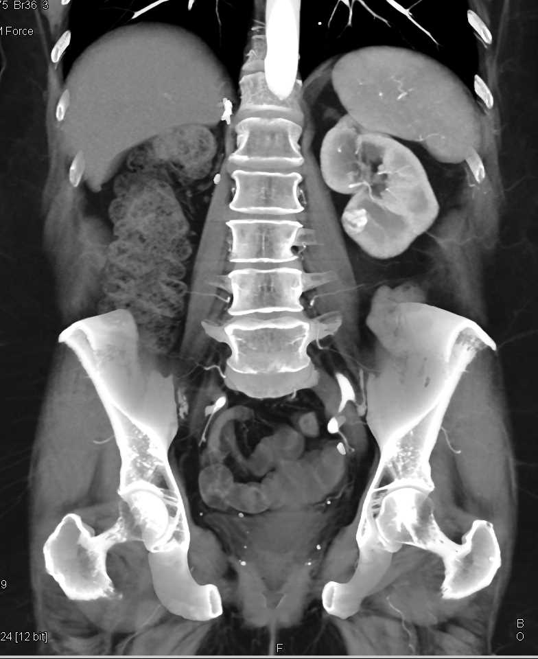 2cm Clear Cell Renal Cell carcinoma Left Kidney in Patient with Prior Nephrectomy - CTisus CT Scan