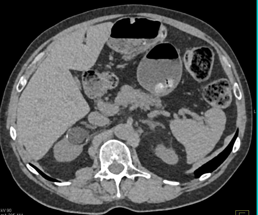 Transitional Cell Carcinoma (TCC) Right Kidney - CTisus CT Scan