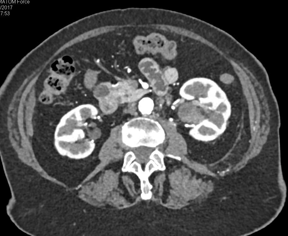 Transitional Cell Carcinoma Left Renal Pelvis and Extends in the Ureter - CTisus CT Scan