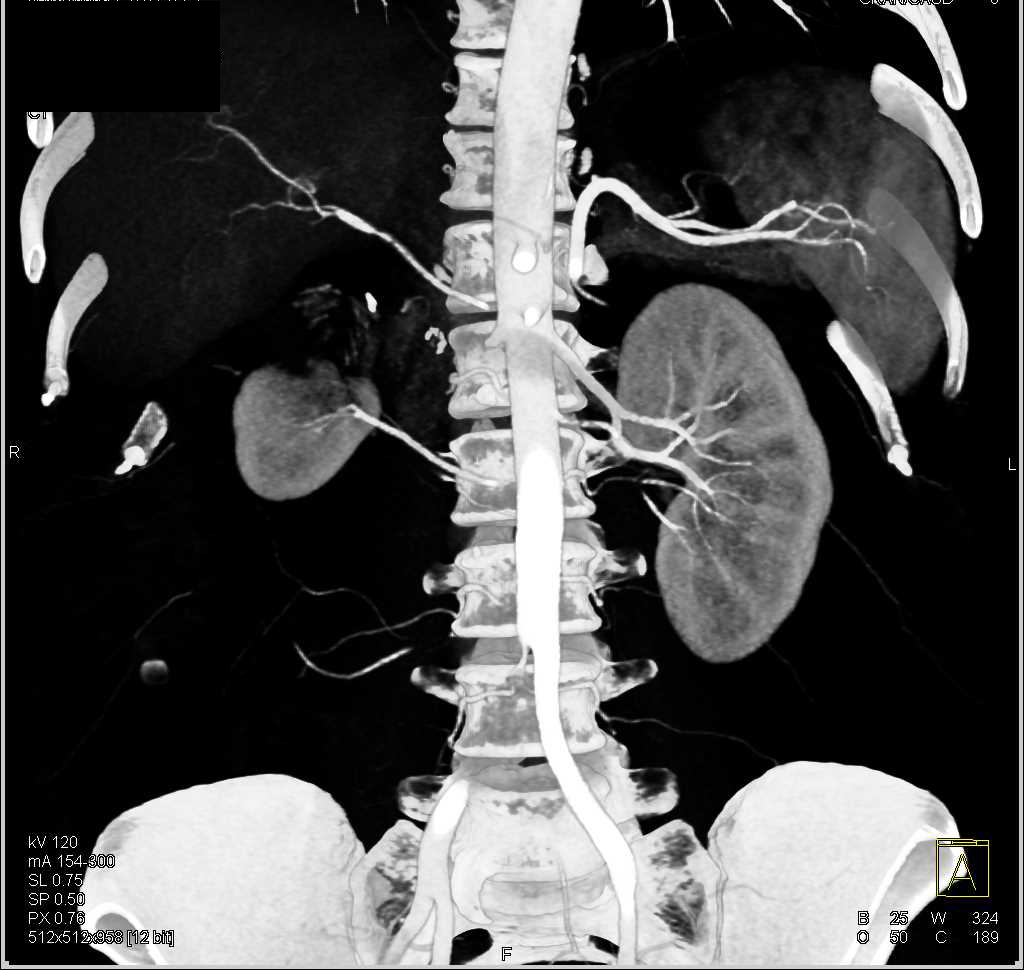 Scarring Upper Pole Right Kidney - CTisus CT Scan