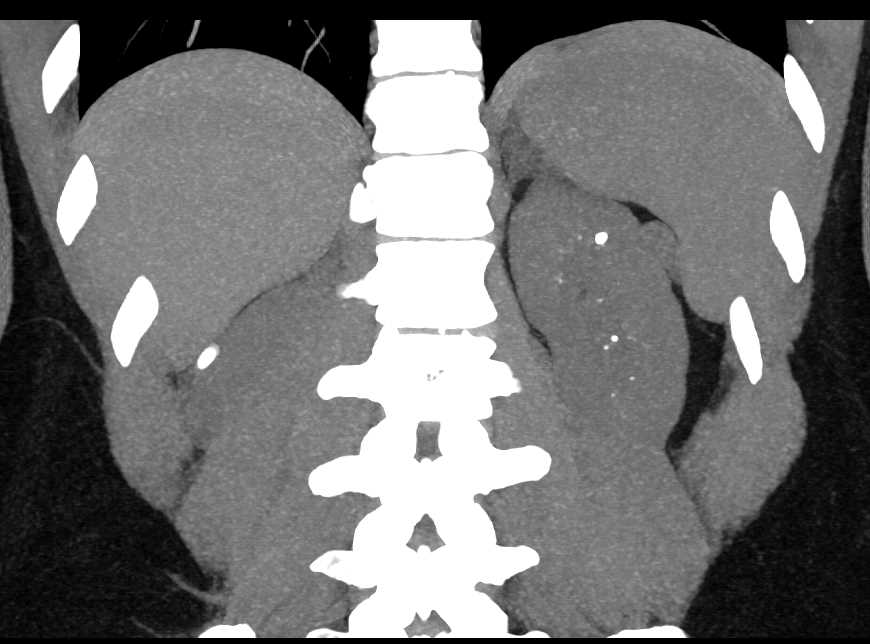 Medullary Sponge Kidney - CTisus CT Scan