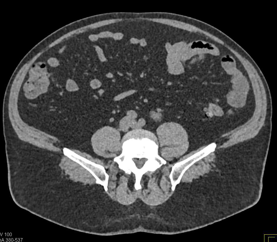 Normal Left Renal Vein - CTisus CT Scan