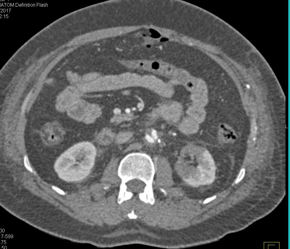 Infarction Left Kidney - CTisus CT Scan