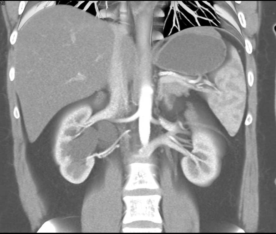 Right Hydronephrosis due to Crossing Vessel (lower pole renal artery) - CTisus CT Scan