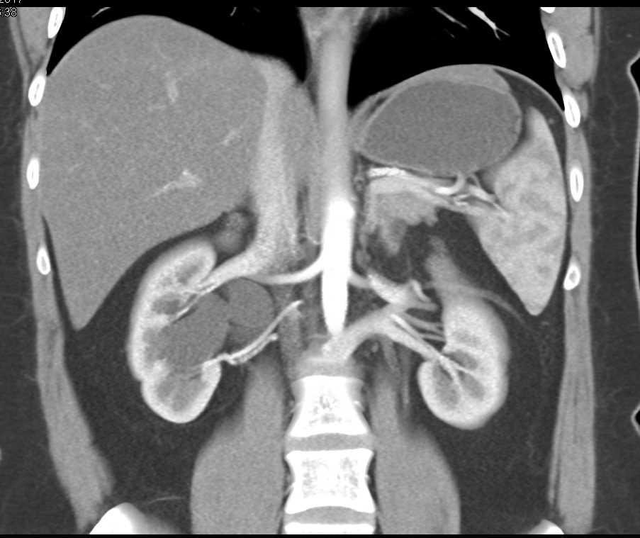 Right Hydronephrosis due to Crossing Vessel (lower pole renal artery) - CTisus CT Scan