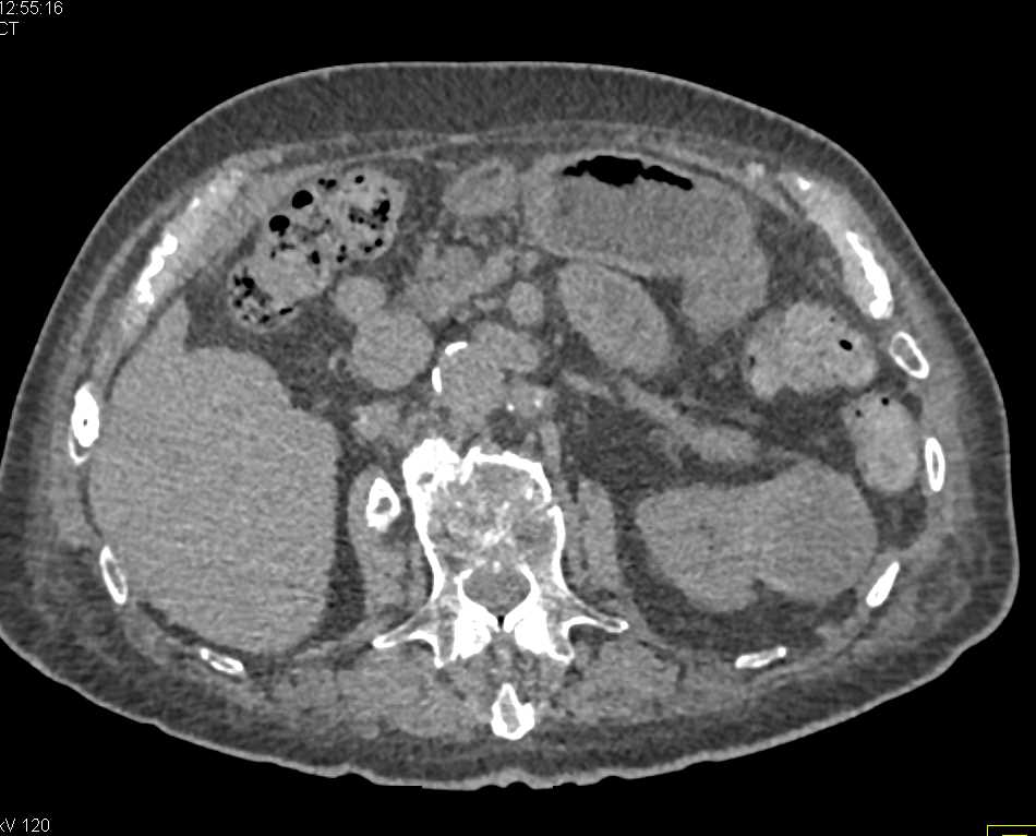 Cystic Left Renal Cell Carcinoma - CTisus CT Scan