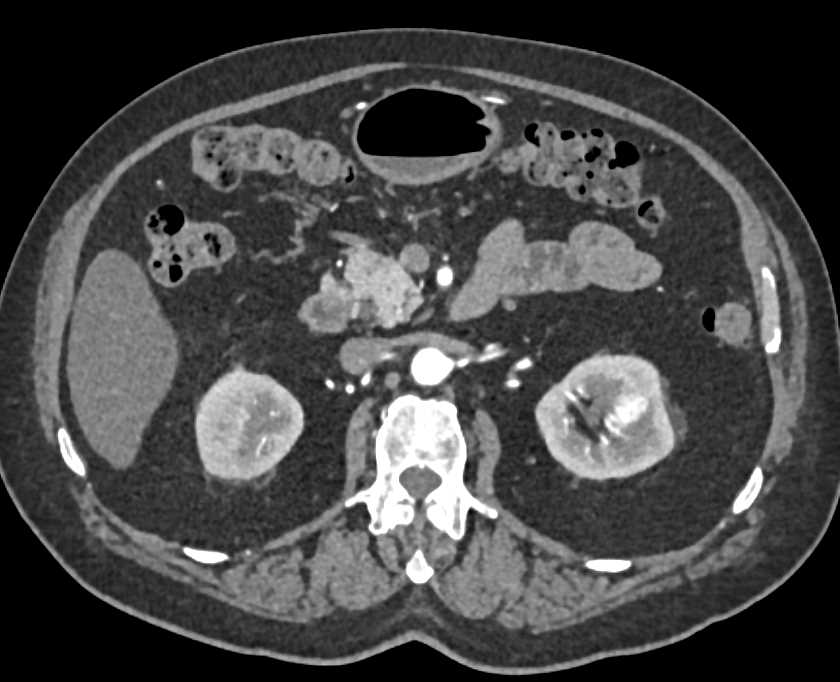 Vascular Malformation Left Kidney - CTisus CT Scan