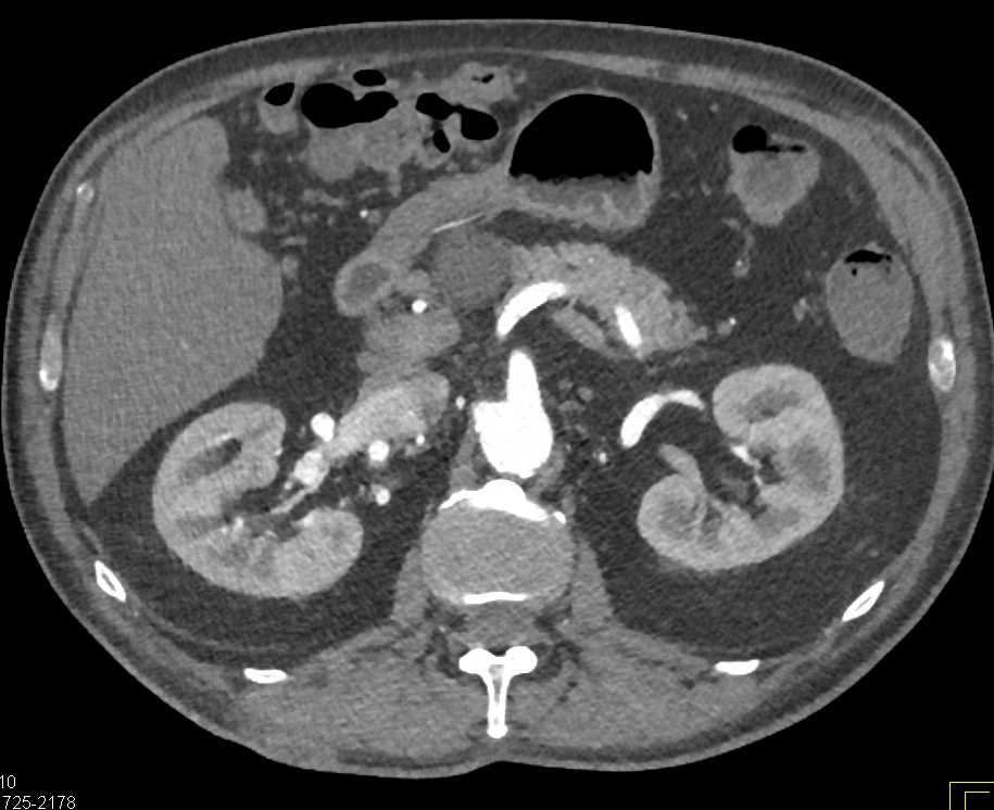 AV Fistulae Right Kidney - CTisus CT Scan