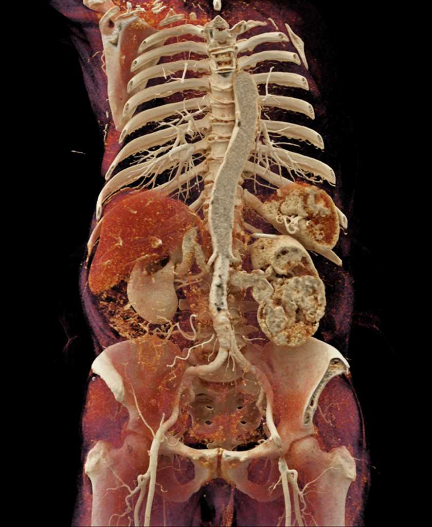 Clear Cell Carcinoma Left Kidney - CTisus CT Scan
