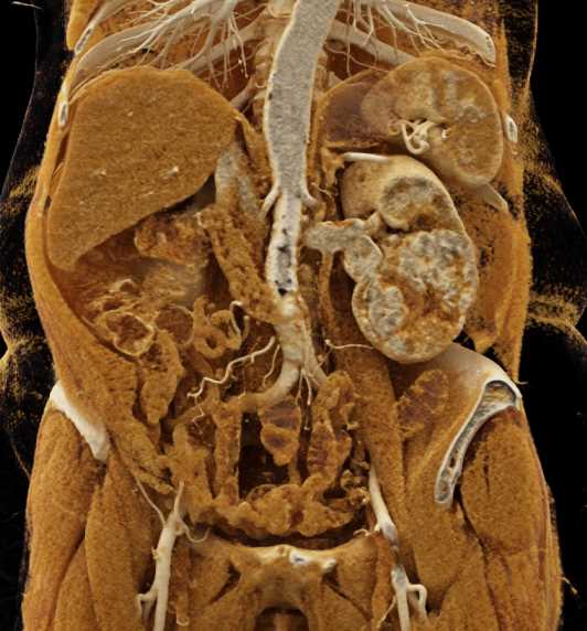 Clear Cell Carcinoma Left Kidney - CTisus CT Scan