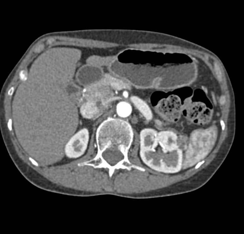 Renal Cell Carcinoma Left Kidney - CTisus CT Scan