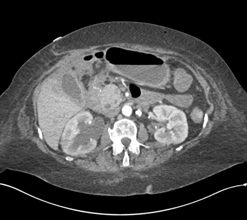 Obstructed Right Kidney with Inflammation - CTisus CT Scan