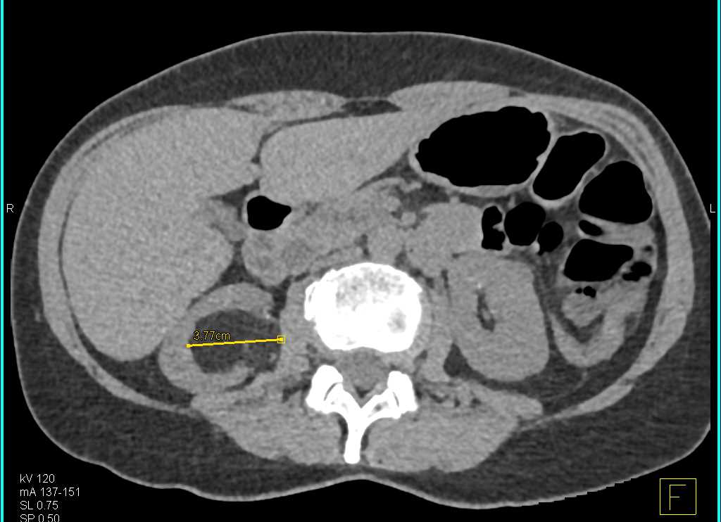 Renal Angiomyolipoma - CTisus CT Scan