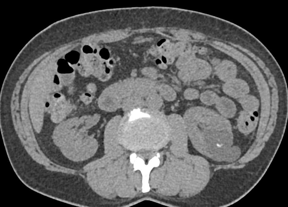 Bosniak 2F Cyst Left Kidney - CTisus CT Scan