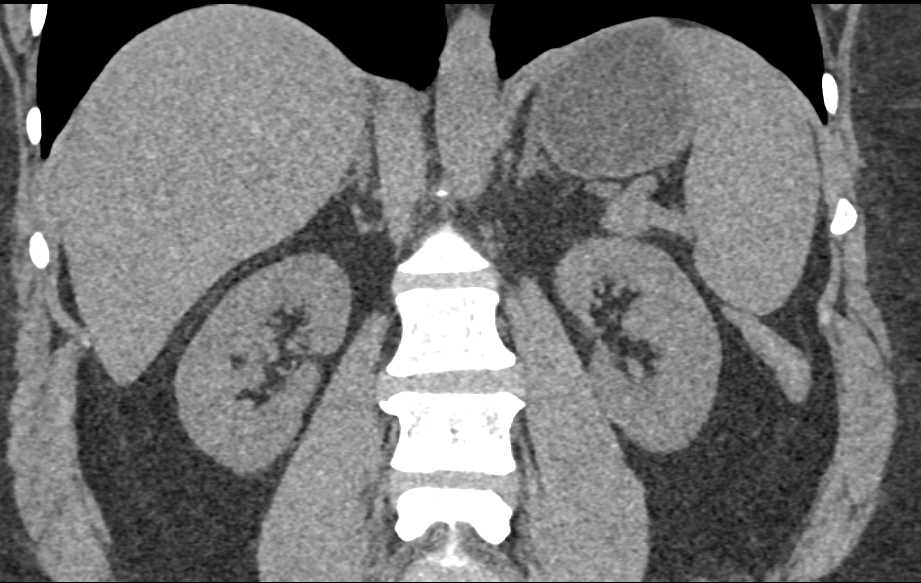 1 cm Right Renal Angiomyolipoma (AML) - CTisus CT Scan