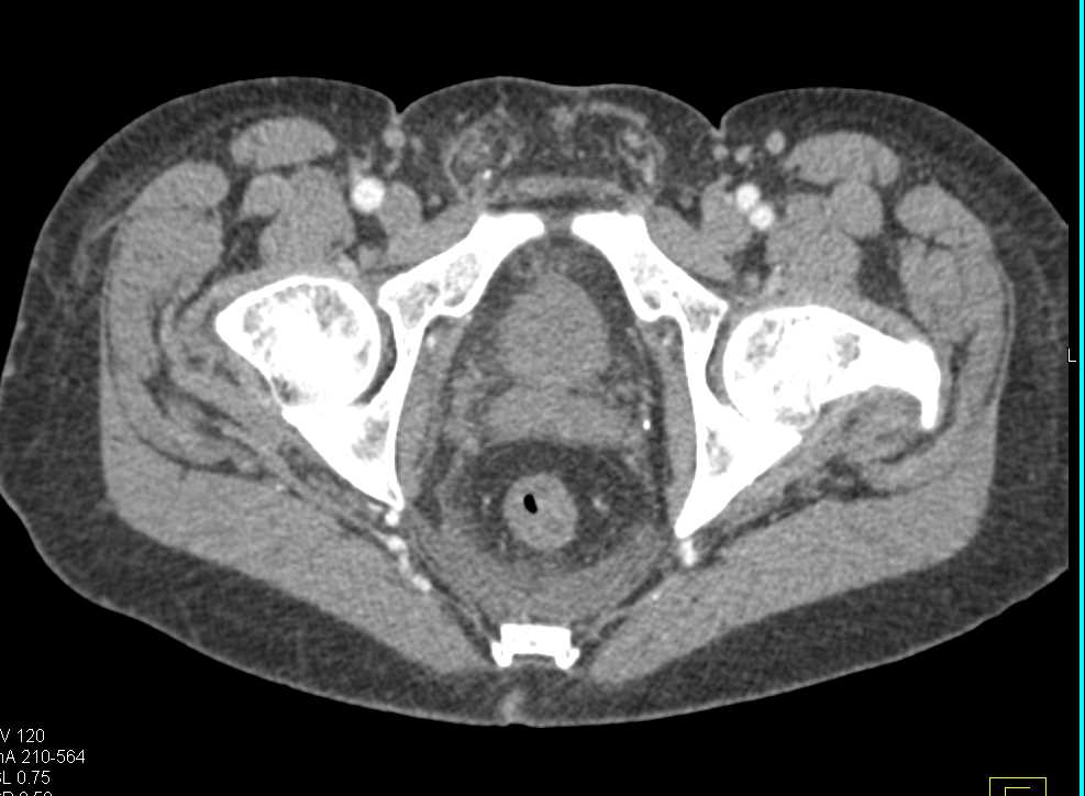 Spontaneous Bleed Around the Right Kidney in a Patient with End Stage Renal Disease (ESRD) - CTisus CT Scan