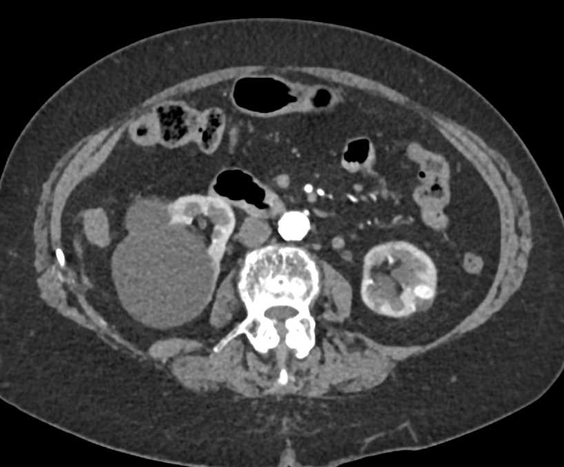 Incidental Renal Cell Carcinoma (RCC) Left Kidney - CTisus CT Scan