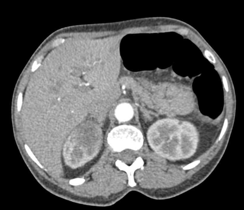 Acute Pyelonephritis Upper Pole Right Kidney - CTisus CT Scan